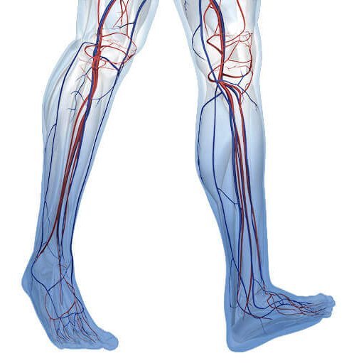 Darstellung der Anatomie von Beinen mit einer Erkrankung an einer chronisch-venösen Insuffizienz (CVI). Dahinter verbirgt sich eine allgemeine Venenschwäche.