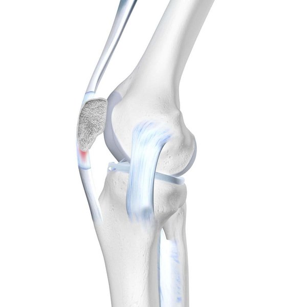 Darstellung der Anatomie des Knies bei einer Patellasehnenreizung. 