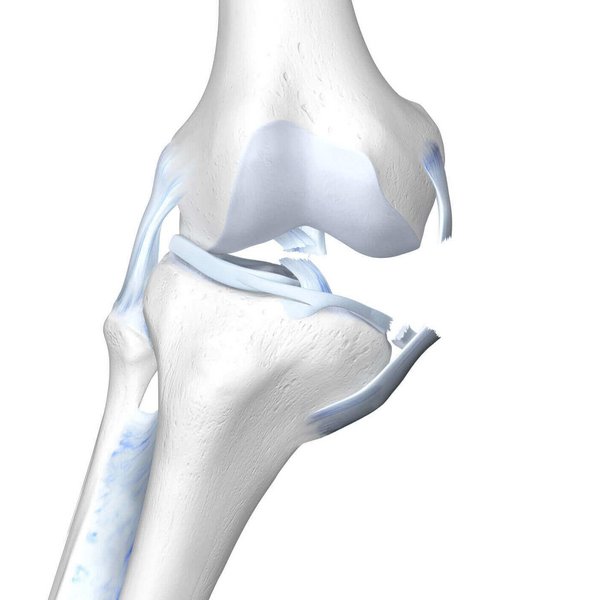 Illustration der Anatomie des Knies bei einem "Unhappy Triad". 