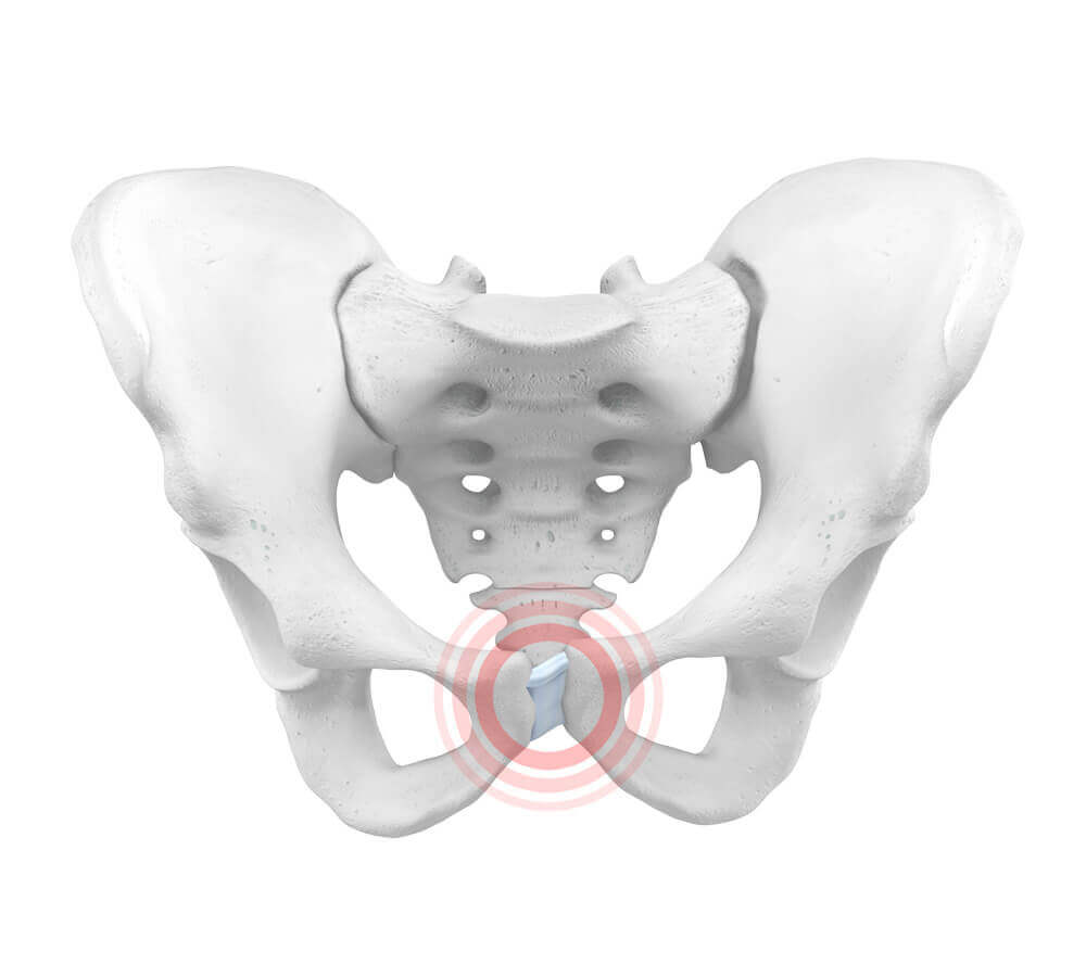 Illustration der Anatomie des Beckens bei einer Symphysenlockerung, auch als Beckenringinstabilität oder Beckenschwäche bezeichnet. Sie äußert sich unter anderem in Schmerzen im Becken, Kreuzschmerzen, ISG-Reizungen und Bewegungseinschränkungen.