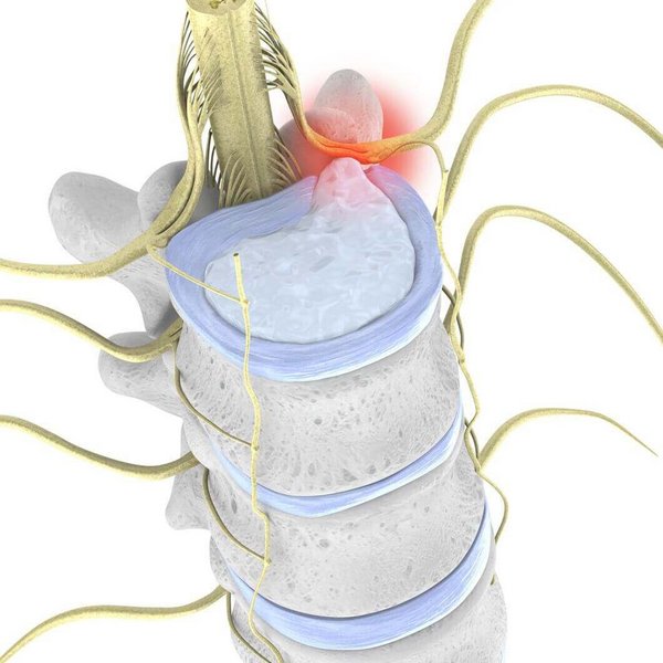Illustratie van de anatomie van de wervelkolom bij een hernia: het schijfweefsel puilt naar voren of treedt volledig uit (prolaps).