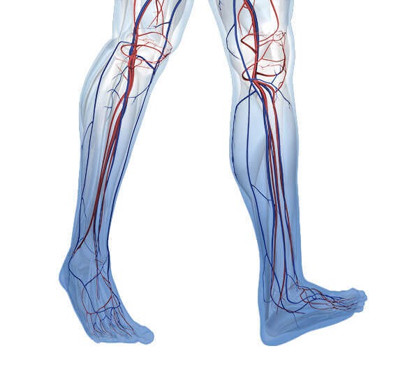 Weergave van de anatomie van benen met chronisch veneuze insufficiëntie (CVI). Hierachter gaat een algemene aderzwakte schuil.