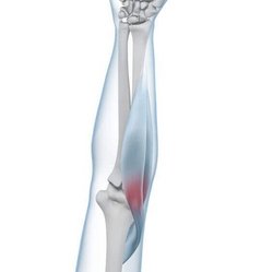 Weergave van de anatomie van de elleboog met een tennisarm-aandoening.
