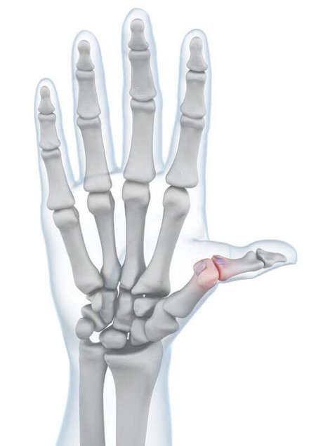 Weergave van de anatomie van de hand met een aanwezige skiduim-aandoening.