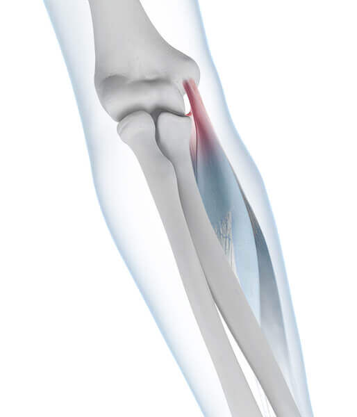Illustratie van de anatomie van de elleboog met een golferselleboog. Bij de golferselleboog (epicondylitis ulnaris humeri, epicondylitis medialis humeri) zijn de spieraanhechtingen aan de binnenkant van de elleboog ontstoken of beschadigd.