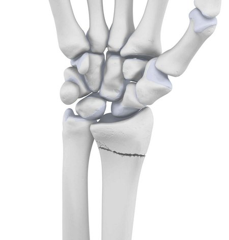 Weergave van de anatomie van de hand met een radiusfractuur.