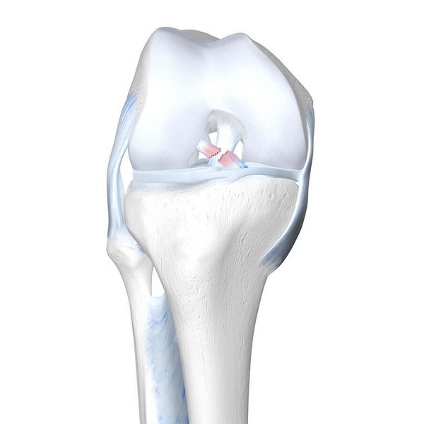 Weergave van de anatomie van de knie bij een aanwezige kruisbandscheur.