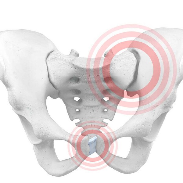 Weergave van de anatomie van het bekken bij een bekkenringinstabiliteit. Vooral zwangere vrouwen worden door de enorme verandering en belasting van het lichaam vaak door een bekkenringinstabiliteit getroffen.