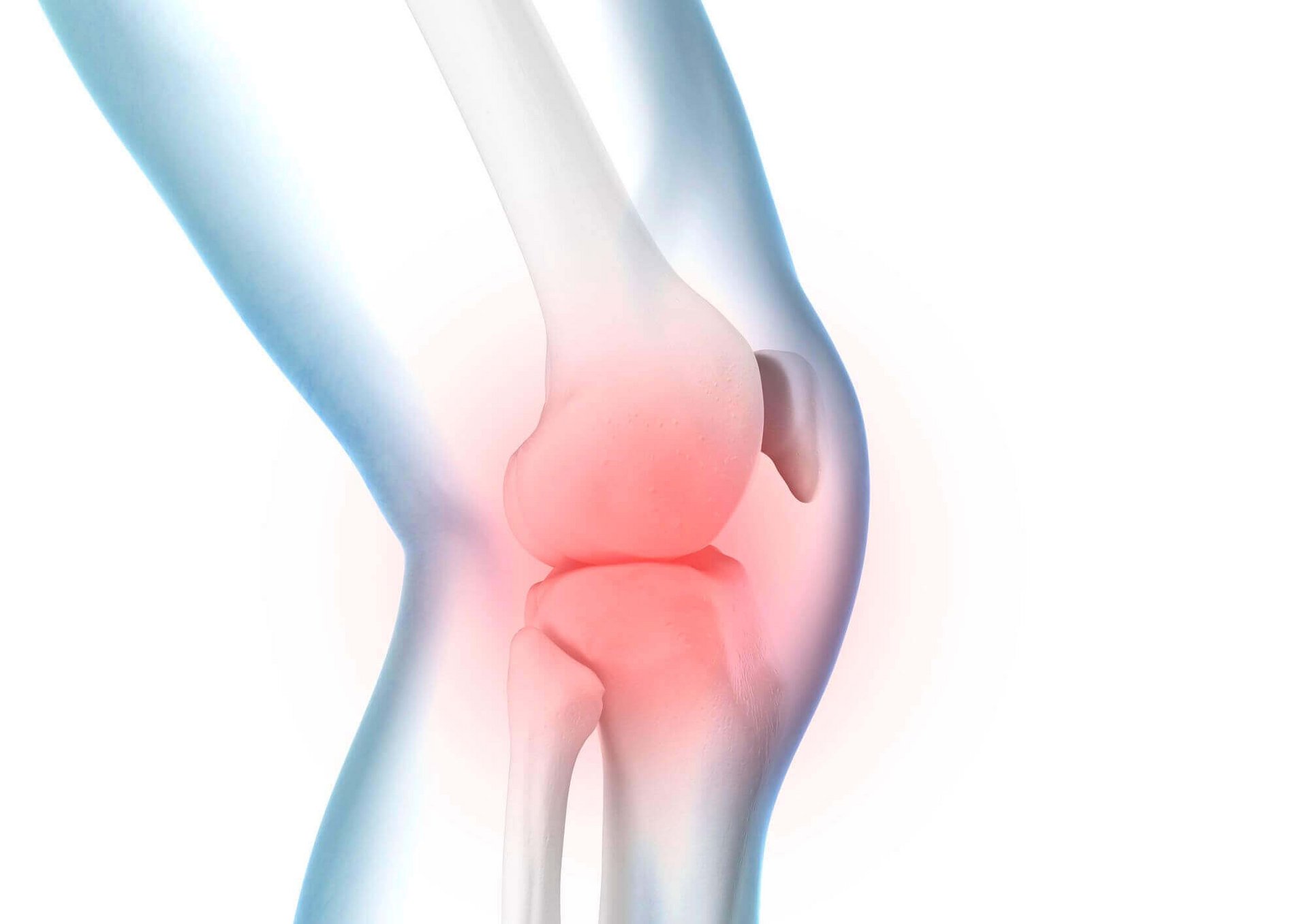 Illustratie van de anatomie van de knie bij een vochtophoping in de knie.