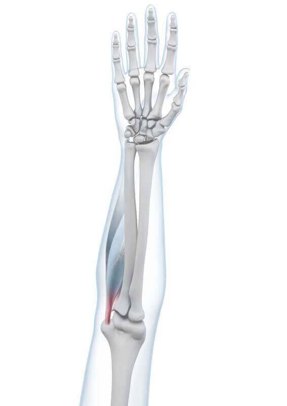 Illustratie van de anatomie van de elleboog met een golfarm.