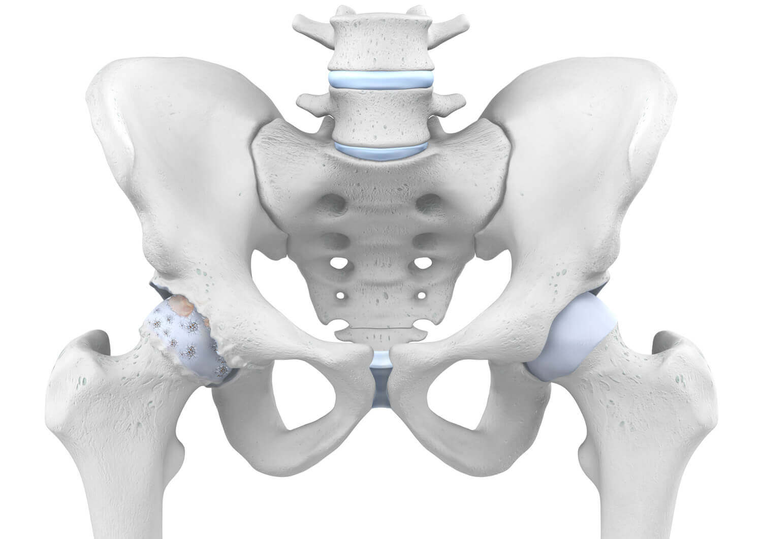 Anatomische weergave van een heup met coxartrose.