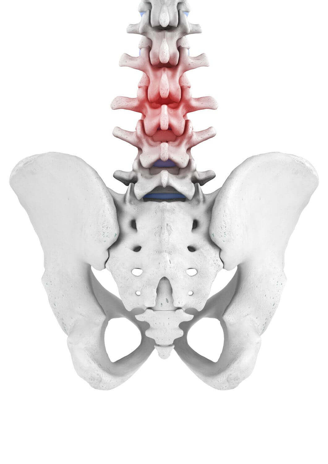 Weergave van de anatomie van de wervelkolom bij een aanwezig LWK-syndroom. Onder een acuut LWK-syndroom, in de volksmond ook spit genoemd, verstaat men een heel plotseling optredende, zeer heftige en stekende pijn in het gebied van de lendenwervelkolom.