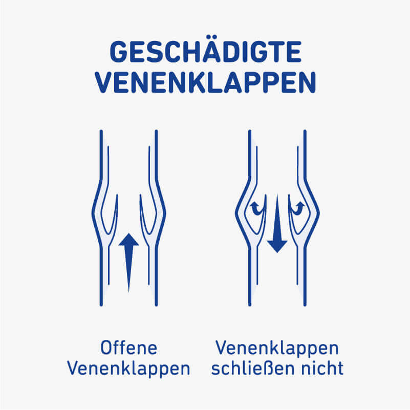 Een illustratieve afbeelding van beschadigde aderkleppen.