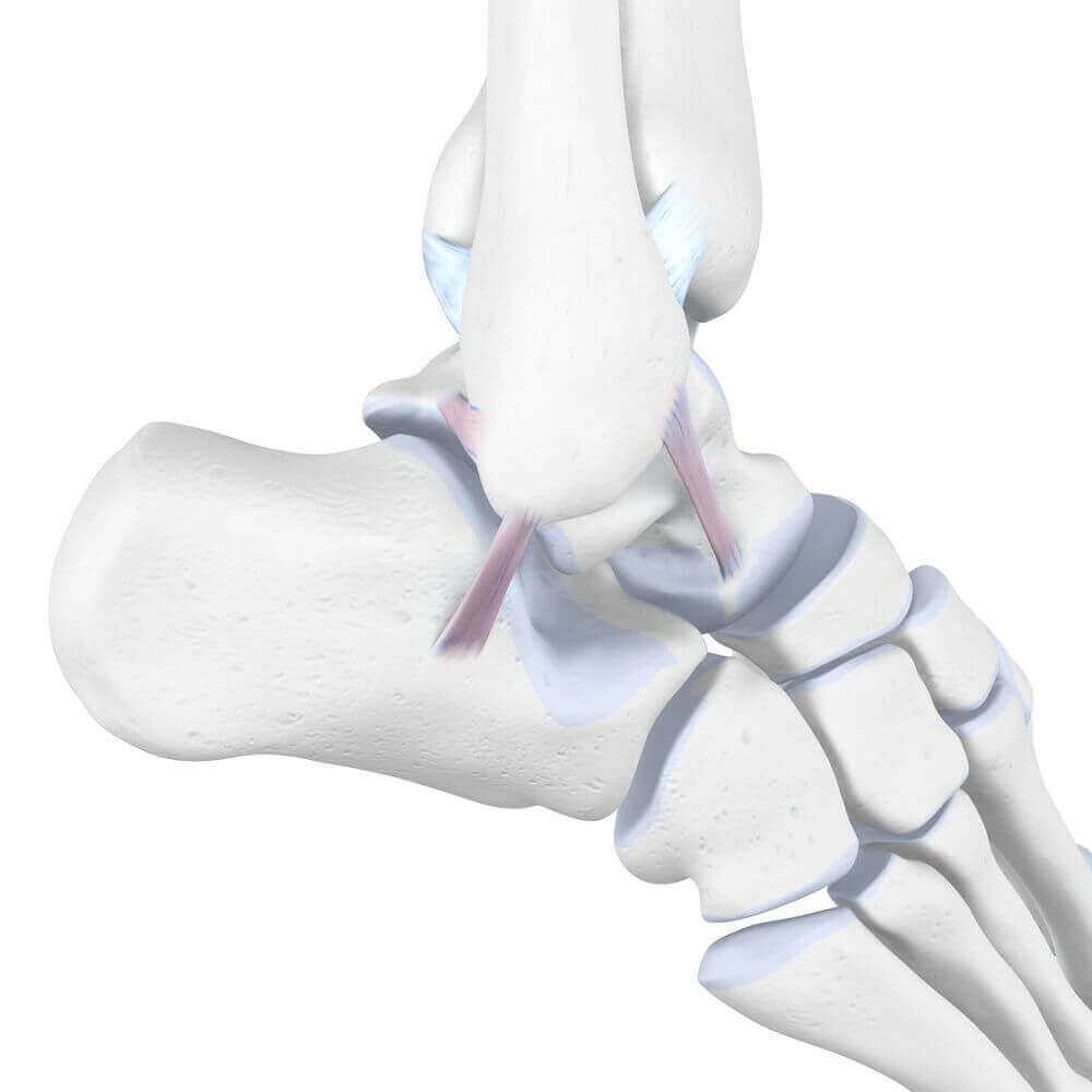 Weergave van de anatomie van het enkelgewricht bij een bandverrekking. Een bandverrekking in de enkel ontstaat vooral wanneer de voet overmatig naar binnen of buiten wordt gedraaid.
