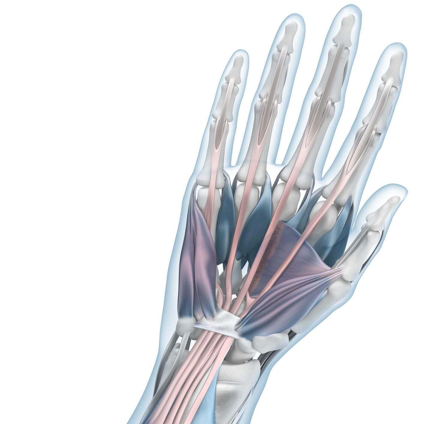 Weergave van de anatomie van de arm met een muisarmaandoening (RSI-syndroom).