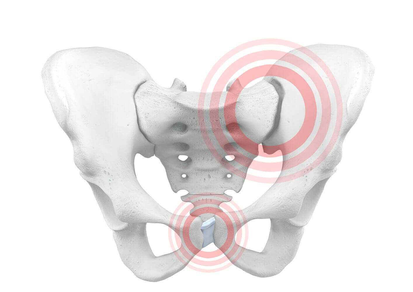 Weergave van de anatomie van het bekken bij een bekkeninstabiliteit. Vooral zwangere vrouwen krijgen vaak te maken met bekkeninstabiliteit door de enorme verandering en belasting van het lichaam.