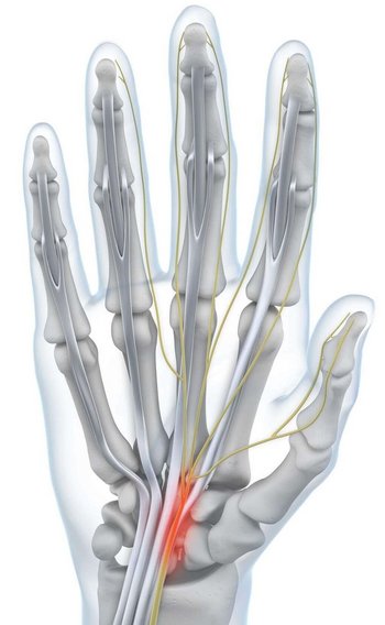 Weergave van de anatomie van de hand bij een bestaand carpaletunnelsyndroom.