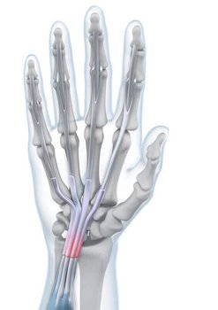 Weergave van de anatomie van de hand bij een aanwezige peesschede-ontsteking.
