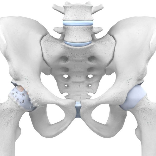 Anatomische weergave van een heup met coxartrose.