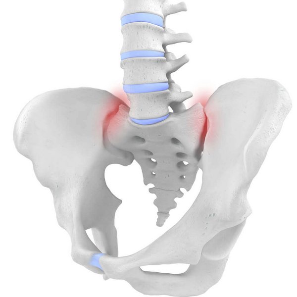 Weergave van de anatomie van het bekken met een SI-syndroom (sacro-iliacaalgewricht-syndroom). Al de kleinste verschuivingen in het sacro-iliacaalgewricht veroorzaken onder omstandigheden hevige rugpijn.
