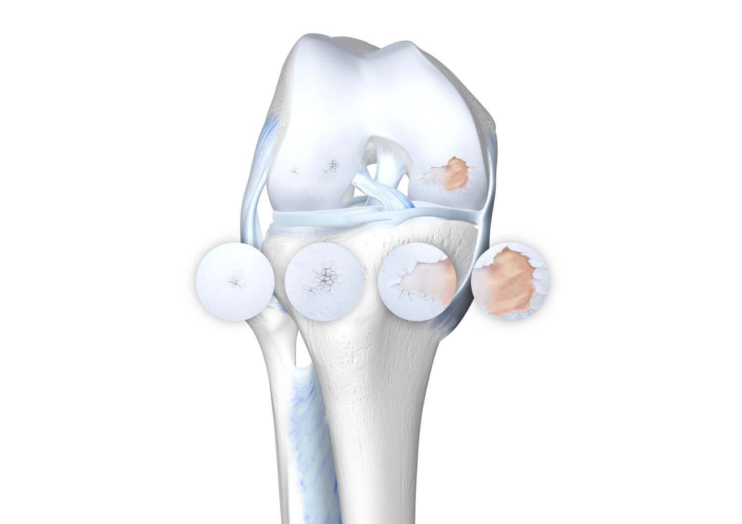 Illustratie van de anatomie van de knie bij knieartrose, inclusief de vier stadia.