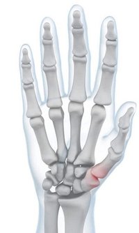 Illustratie van de anatomie van de hand bij optredende pijn in het duimgewricht
