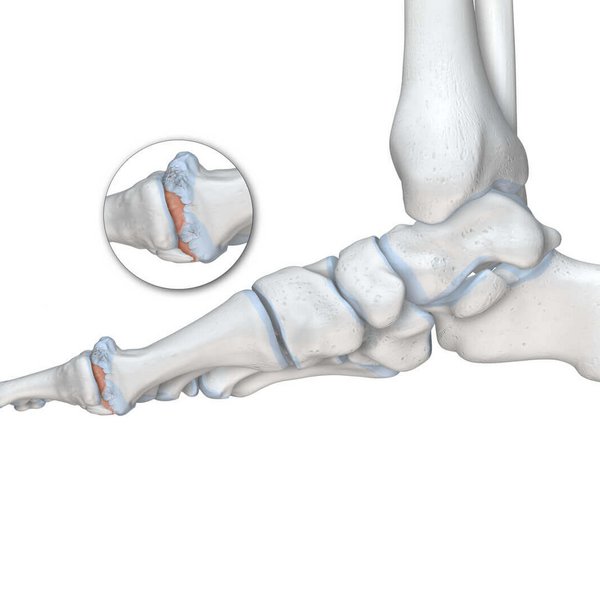 Schematische weergave van de anatomie van de voet met focus op de grote teen bij een hallux rigidus.