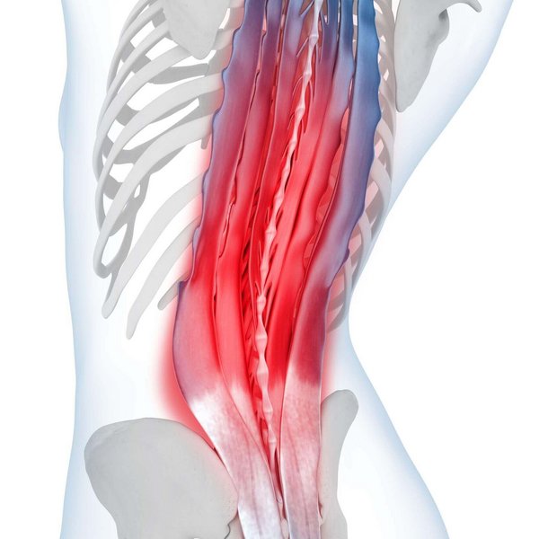 Illustratie van de anatomie van de rug bij verspanningen. Verspanningen van de rugspieren leiden tot pijn in het gebied van de lendenwervelkolom. Die kunnen zich langzaam ontwikkelen of, zoals bij spit, plotseling opschieten.