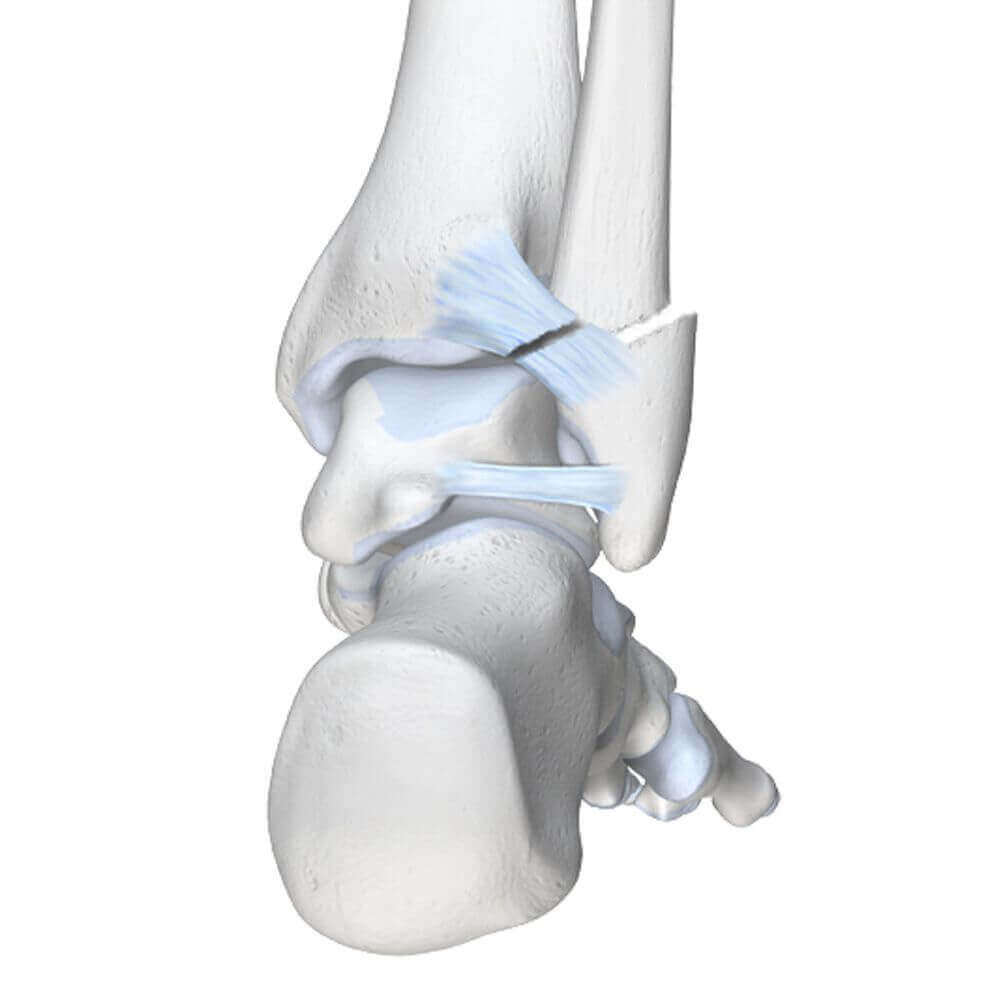 Weergave van de anatomie van een gebroken enkel. Bij een verkeerde landing of een verdraaide voet ontstaan er vaak breuken in het bovenste deel van de enkel.