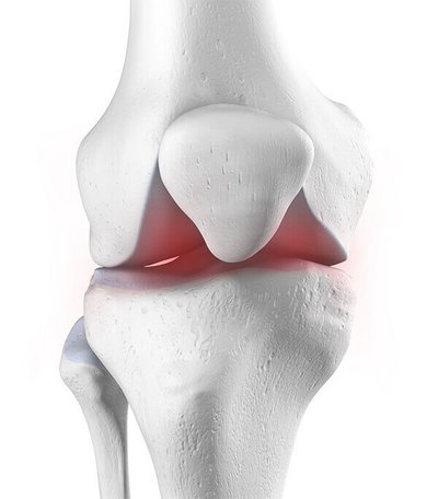 Anatomische weergave van een kniegewricht dat door artritis is aangedaan.