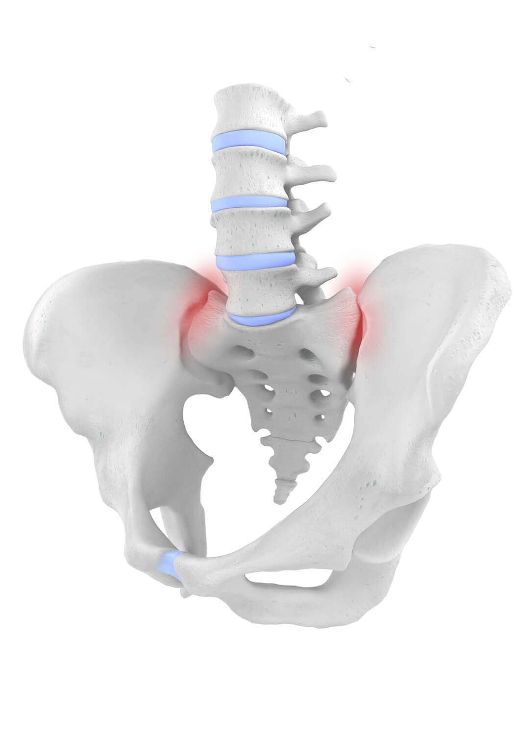 Weergave van de anatomie van het bekken met een SI-syndroom (sacro-iliacaalgewricht-syndroom). Zelfs de kleinste verschuivingen in het sacro-iliacaalgewricht kunnen onder bepaalde omstandigheden hevige rugpijn veroorzaken.