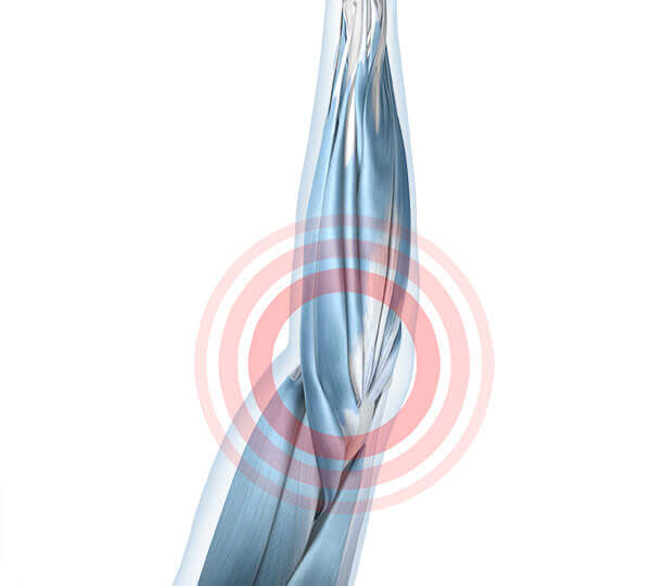 Illustratie van de anatomie van de elleboog met een peesaanhechtingsirritatie.