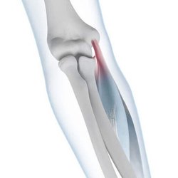 Illustratie van de anatomie van de elleboog met een golferselleboog. Bij de golferselleboog (epicondylitis ulnaris humeri, epicondylitis medialis humeri) zijn de spieraanhechtingen aan de binnenzijde van de elleboog ontstoken of beschadigd.