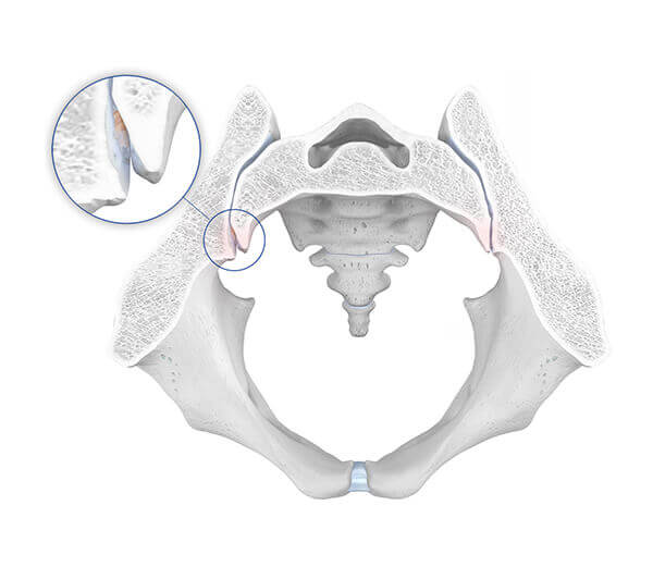 Illustratie van de anatomie van de heup bij een bestaande SI-artrose.