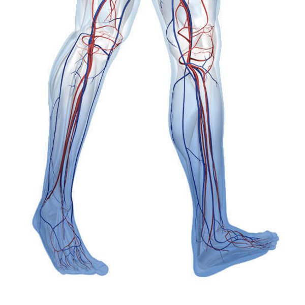 Weergave van de anatomie van benen met een chronisch veneuze insufficiëntie (CVI). Daarachter schuilen zwakke aderen in het algemeen.