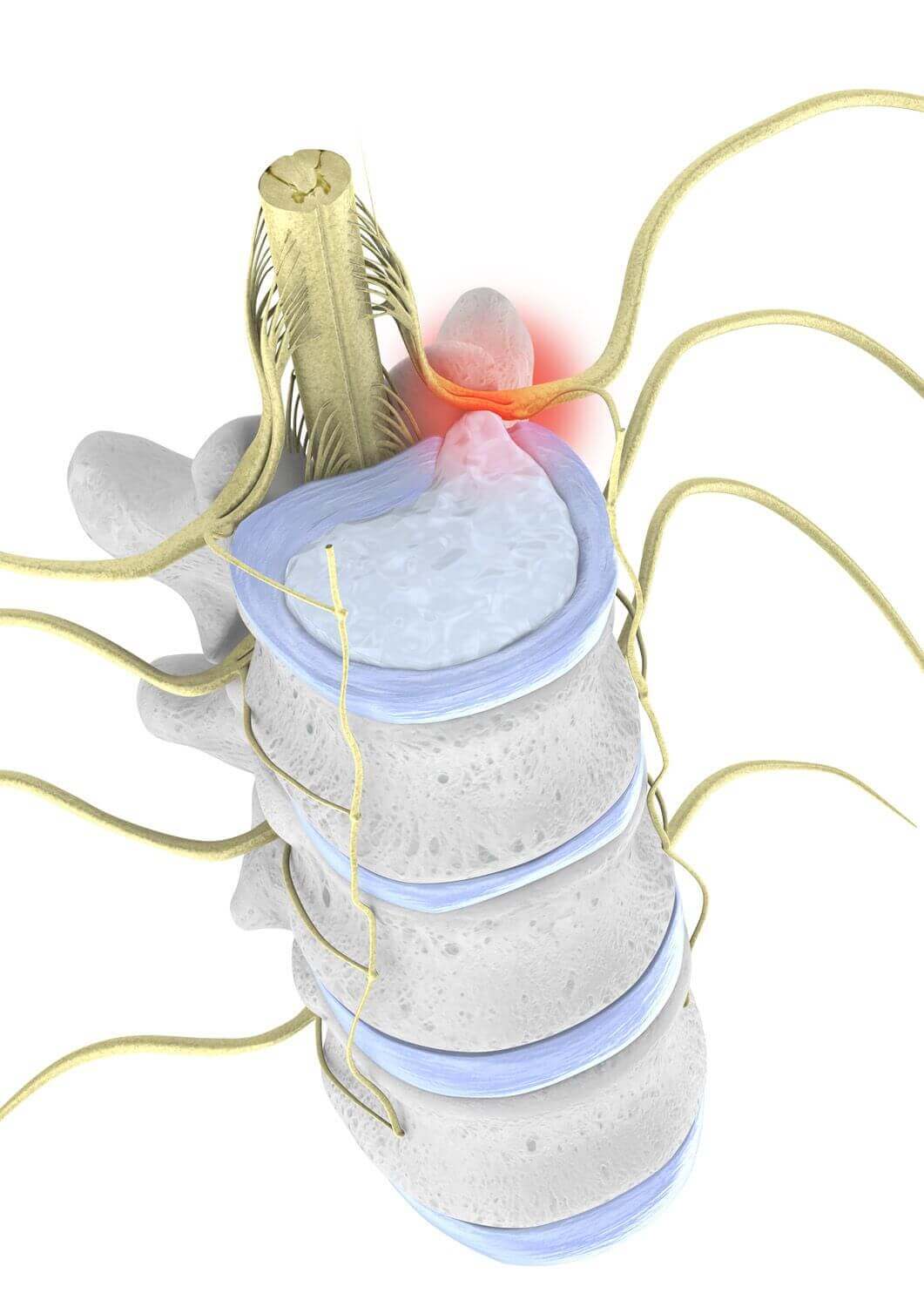 Illustratie van de anatomie van de wervelkolom bij een hernia: het tussenwervelschijfweefsel welft naar voren of treedt volledig naar buiten (prolaps).