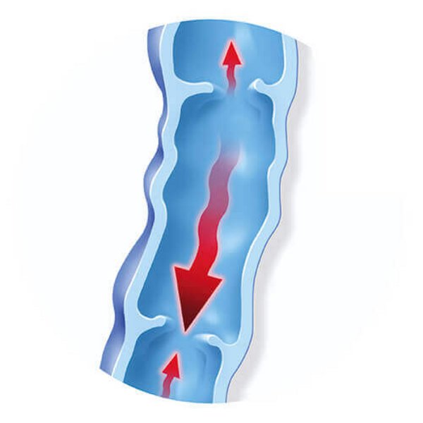 Weergave van de anatomie van een ader bij spataderen (varices): door uitstulpingen van de aderwanden verwijden de aderen. Spataderen komen bij vrouwen vaker voor dan bij mannen.