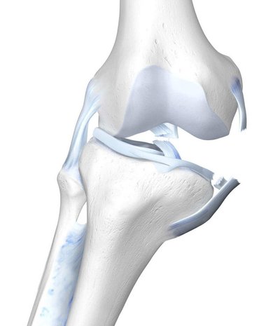 Illustratie van de anatomie van de knie bij een "Unhappy Triad".