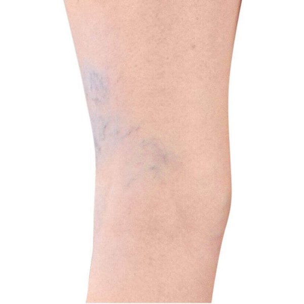 Weergave van de anatomie van de benen bij spataadertjes: verwijdingen van kleine huidaderen die als netvormige lijnen op de huid zichtbaar zijn. Ze ontstaan doordat het bindweefsel van de aderwand uitrekt.