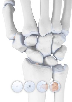 Weergave van de anatomie van een pols bij aanwezige artrose, inclusief de verschillende artrosegraden.