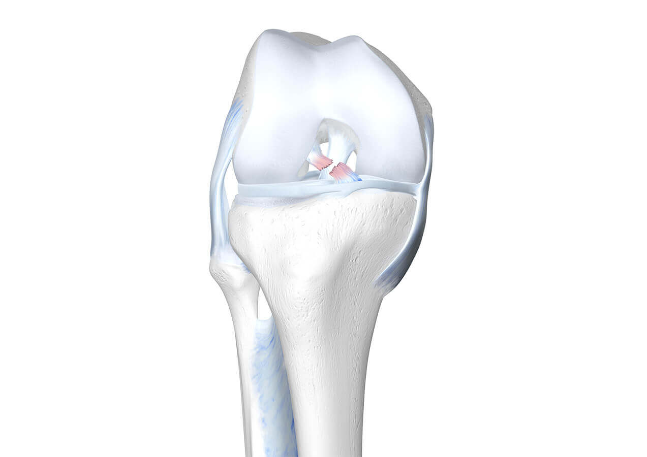 Weergave van de anatomie van de knie bij een aanwezige kruisbandscheur.
