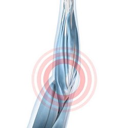 Illustratie van de anatomie van de elleboog met een aanwezige geprikkelde peesaanhechting.