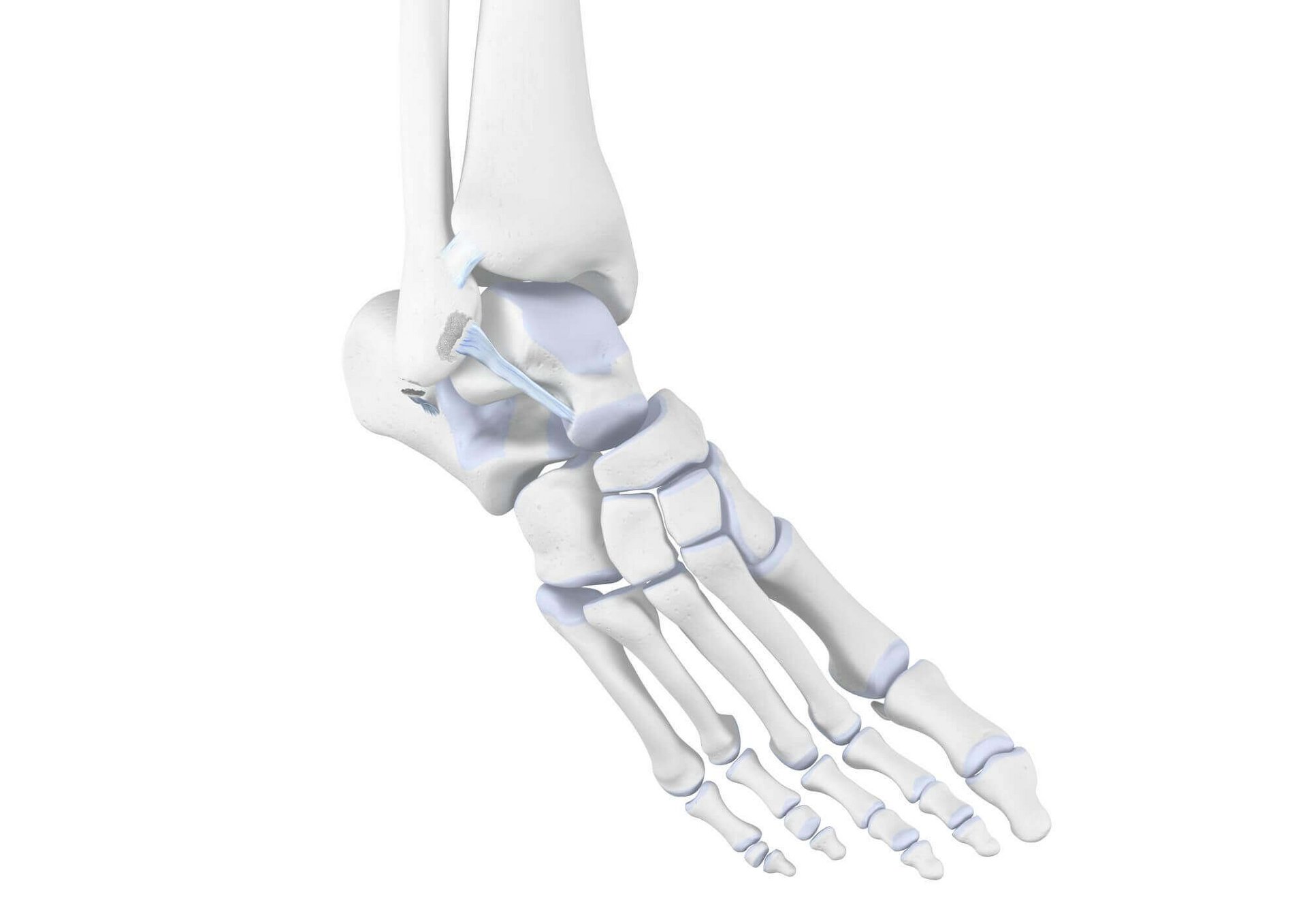 Weergave van de anatomie van de enkel bij een enkeldistorsie: een of meer gewrichten worden met grote kracht voorbij hun fysiologische grens bewogen, waardoor de banden pijnlijk overrekt raken.