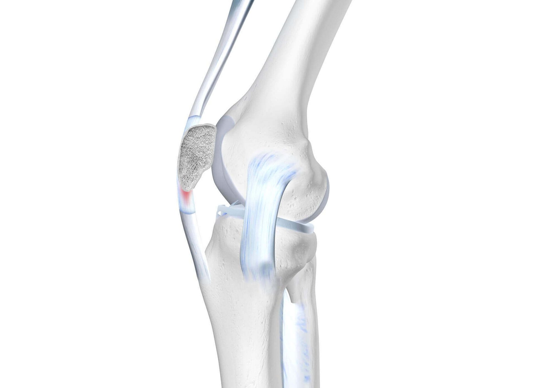 Darstellung der Anatomie des Knies bei einer Patellasehnenreizung.