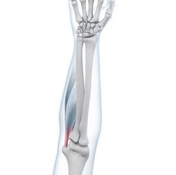 Illustratie van de anatomie van de elleboog met een golfarm.