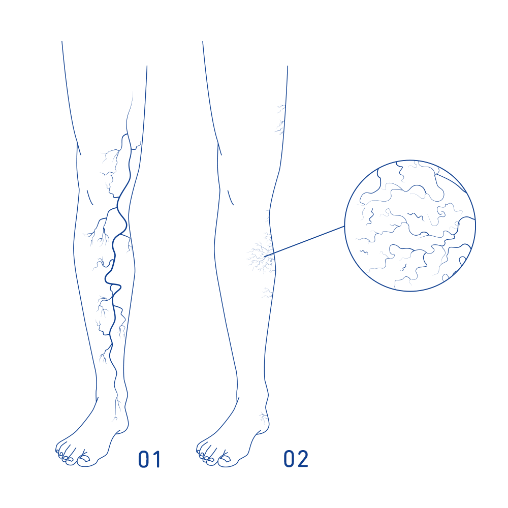 De afbeelding toont op illustratieve wijze het verschil tussen spataderen en spataadertjes.