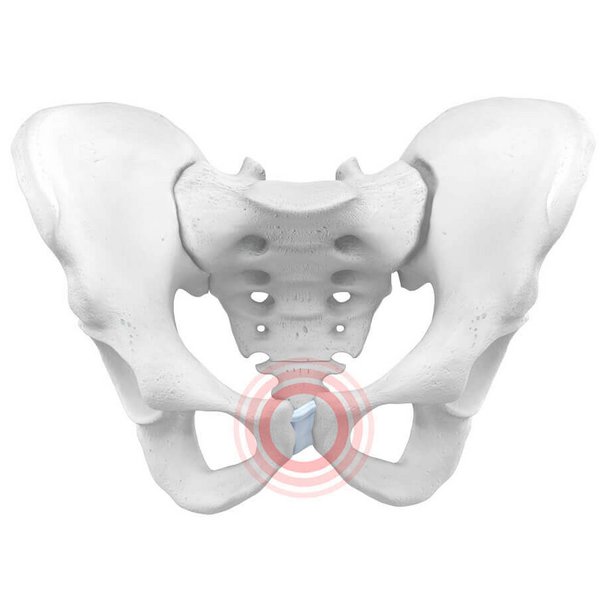 Illustratie van de anatomie van het bekken bij een symfyseverweking, ook aangeduid als bekkenringinstabiliteit of bekkenzwakte. Die uit zich onder andere in pijn in het bekken, lage rugpijn, SI-prikkelingen en bewegingsbeperkingen.